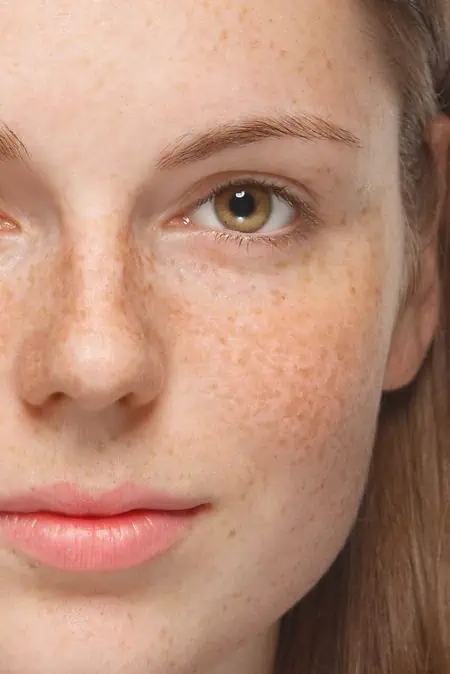 Pigmentation Treatment