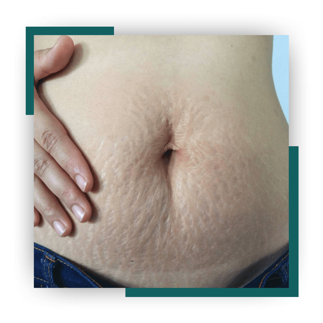 Pregnancy Stretch mark